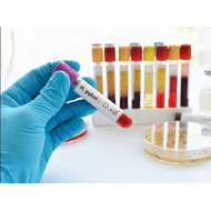 Helicobacter Pylori En Heces